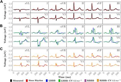 A personalized real-time virtual model of whole heart electrophysiology